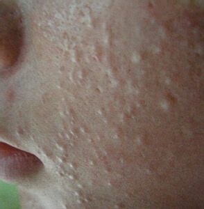 白头粉刺和白头闭口有什么区别,白头丘疹和白头粉刺区别