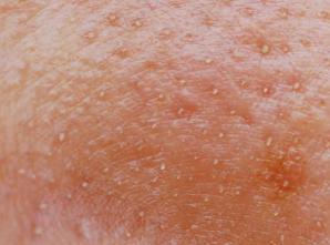 为什么皮肤毛孔粗大,毛孔粗大的真正原因到底是什么