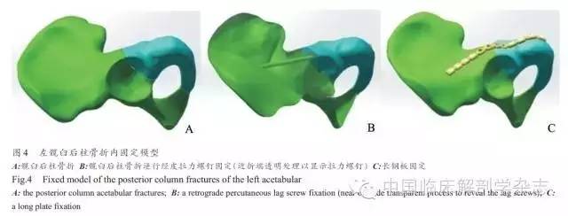 长骨骨折石膏固定术,长骨骨折夹板固定