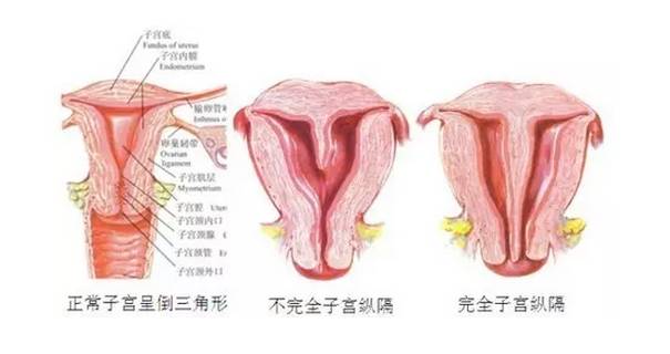 子宫也分“一室”和“二室”你不知道？