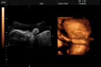 四维彩超胎儿在微笑,怀孕5个月四维检查唇裂