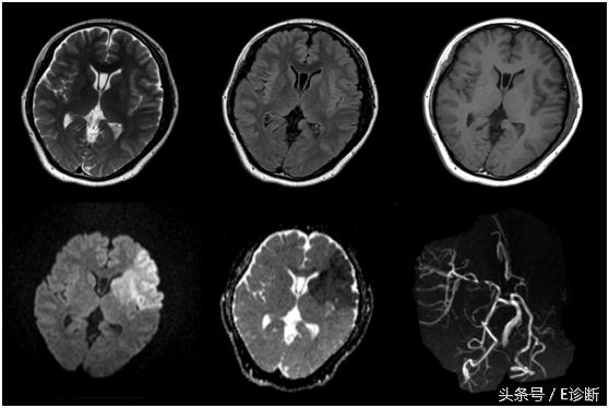 E诊断：脑梗塞影像图解