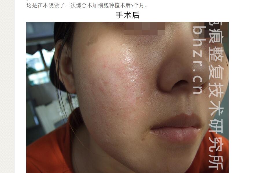 脸上点痣留下的疤痕该怎么办,怎么去除脸上的疤痕