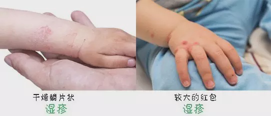 应对痱子的最好方法,痱子有哪几种表现说明得了痱子