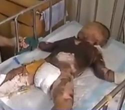 男童被米汤烫伤后续,男孩烫伤被奶奶抹油