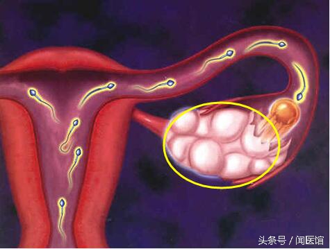 卵巢囊肿手术后的真实经历,卵巢囊肿小5cm多自愈最佳方法