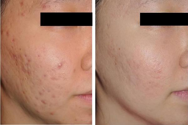 怎么祛痘痘痘疤,痘痘怎么那么容易有痘疤