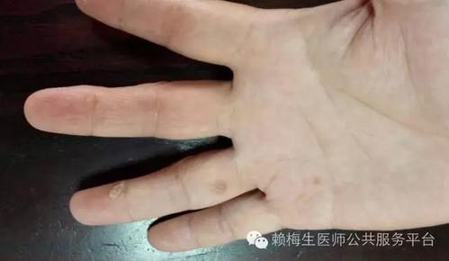 火针灸能治跖疣吗,中医火针治疗丝状疣