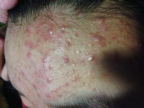 油脂痘该怎么解决,满脸痘怎么调理