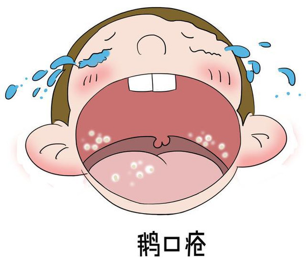 鹅口疮是什么颜色的,鹅口疮是什么颜色
