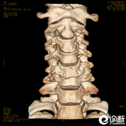 颈椎第五节骨折治疗成功的案例,颈椎骨折的诊断分析
