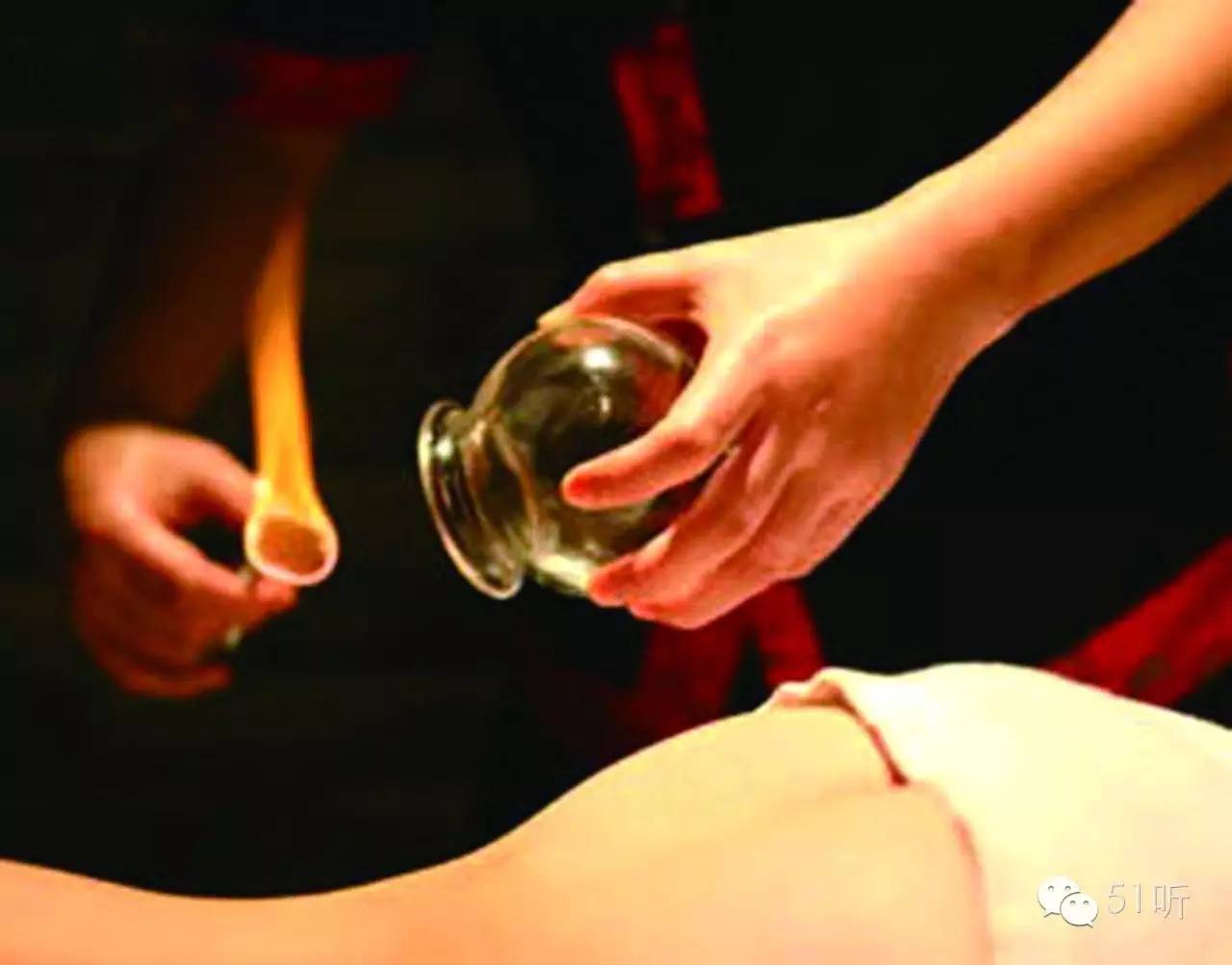 飞鱼菲尔普斯拔罐,飞鱼拔罐