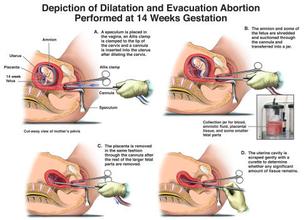 怎么预防人流导致的不孕,有关人流术后注意事项科普