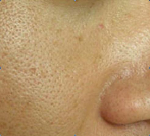 脸上粉刺黑头痘痘毛孔粗大怎么办,黑头闭口毛孔粗大一次性解决