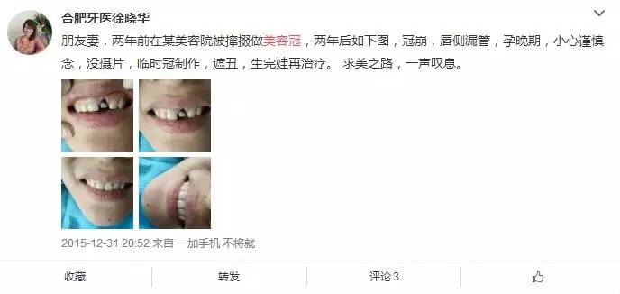即使你放弃了牙齿矫正，也万不能投进“美容冠”的火坑