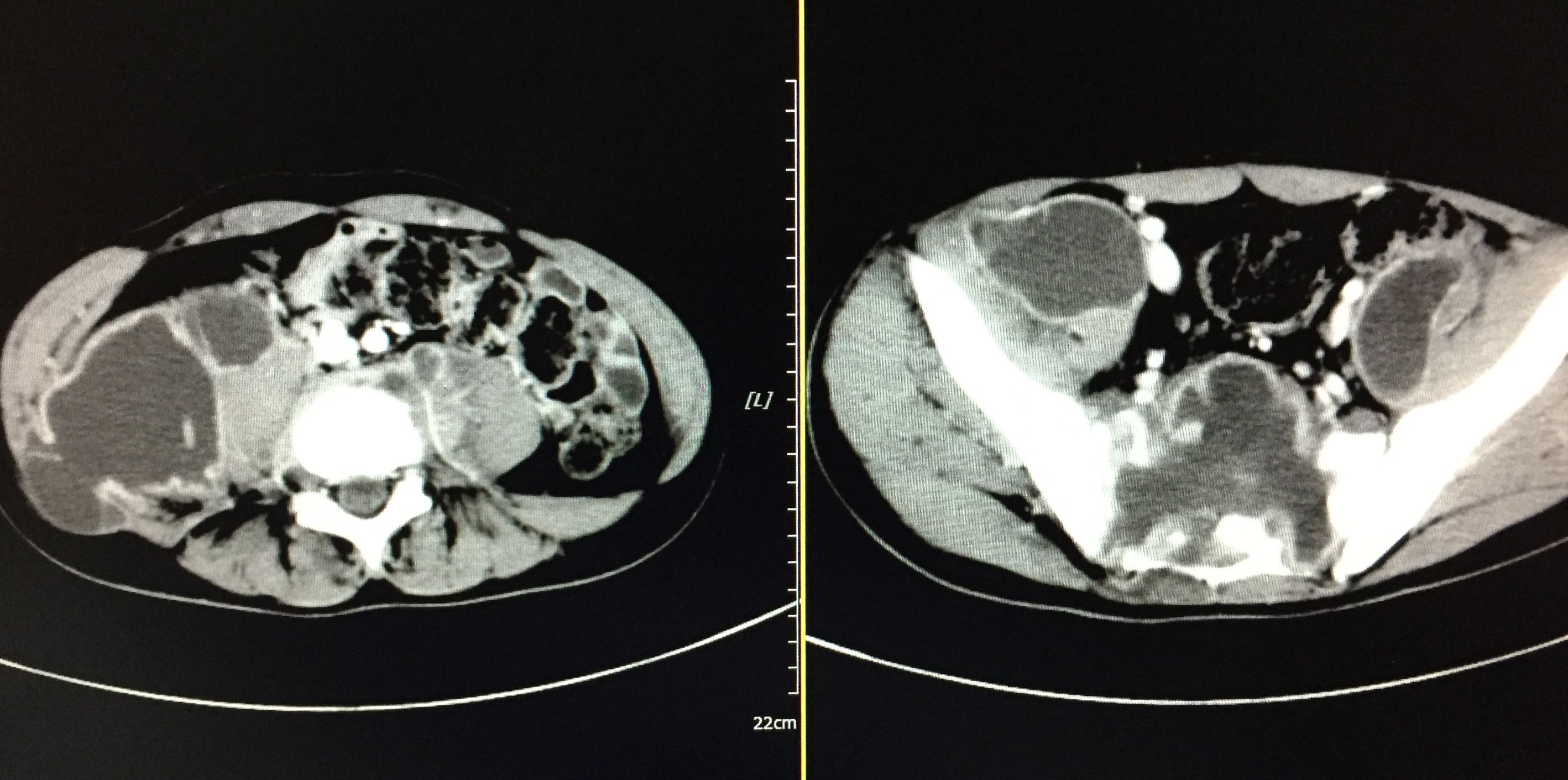 你知道吗？脊柱、盆腔结核脓肿可以穿刺引流联合抗痨治疗。