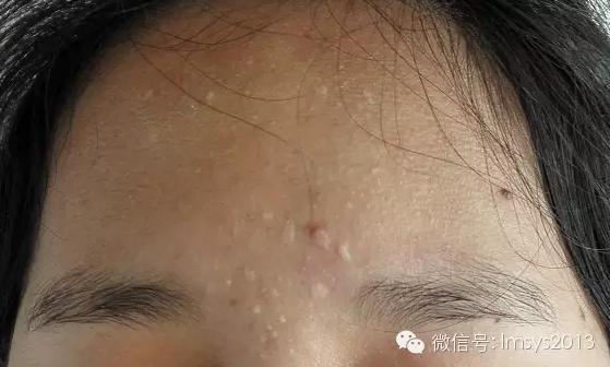 中医火针疗法治疣,中医实战笔记扁平疣秘方