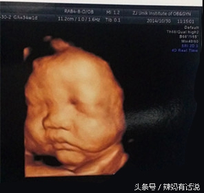 34周引产有生命危险吗,34周引产后的胎儿怎么处理