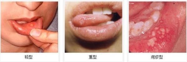 口腔溃疡华素片多久起效,口腔溃疡吃几天黄连上清片起效