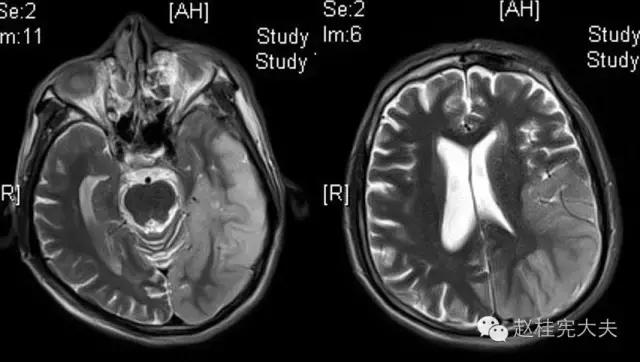 脑卒中简单科普,年轻人是不是不要担心脑卒中