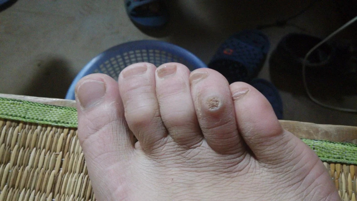 鸡眼病因,鸡眼发病原因与中医治疗