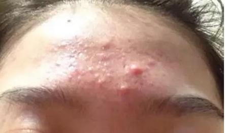 中医脸上反复长粉刺痘痘怎么调理,怎样去脸上粉刺和黑头粉刺