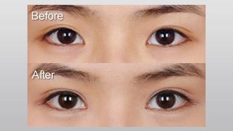 开眼角手术的利与弊,开眼角手术成功的后遗症是什么