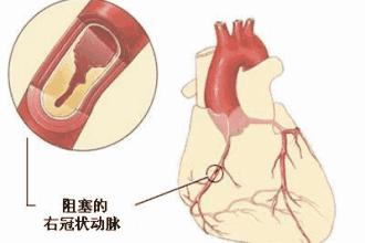 心肌梗死病人能长期喝阿司匹林吗,心肌梗塞后阿司匹林至少吃多久