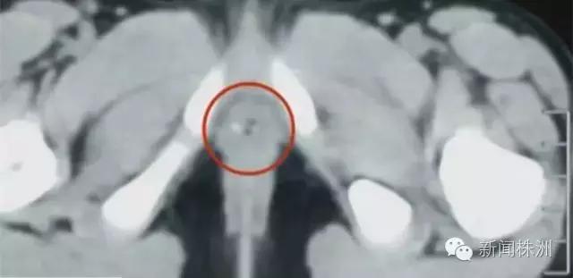 女幼童外阴炎症,7个月女宝外阴炎怎么办