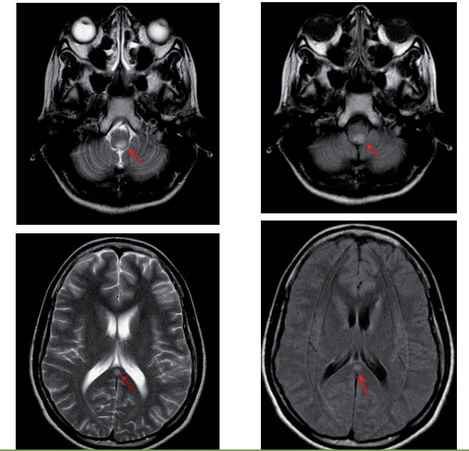 顽固性呕吐是什么意思,反射性呕吐怎么缓解