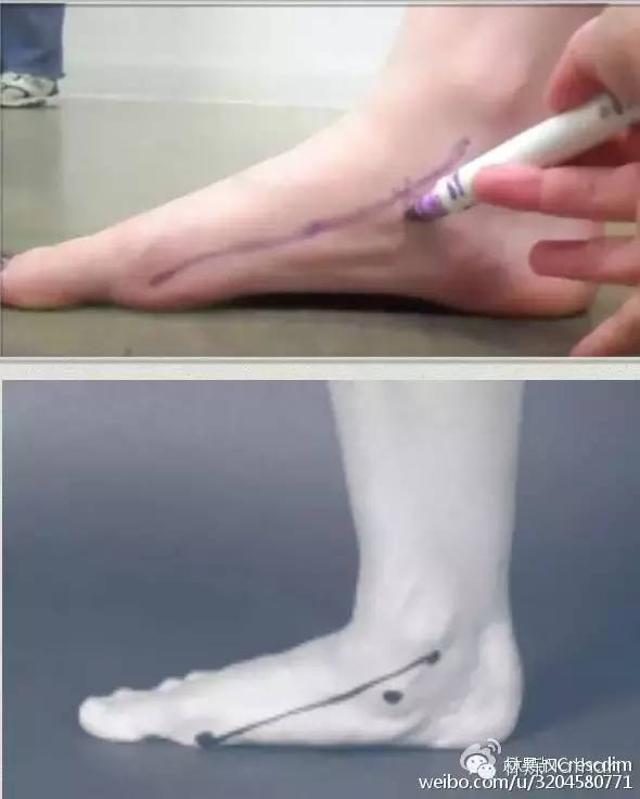 扁平足矫正训练法,扁平足物理治疗能不能恢复足弓