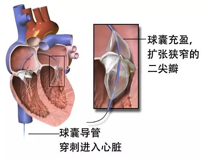 心脏二尖瓣出问题是怎么回事,心脏二尖瓣修复后应注意什么