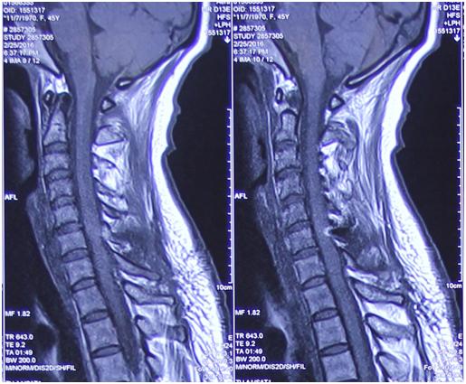 病例分享最后总结,颈静脉孔区神经鞘瘤全切复发概率