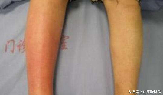 身体出现红色小点是什么病,皮肤上出现红色血管线