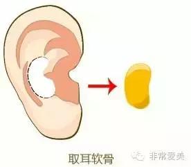 隆鼻太可怕怎么办,硅胶隆鼻正确方法图