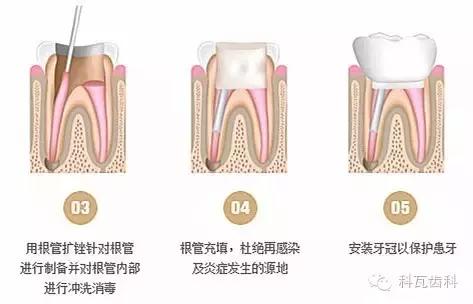 抽牙神经根管治疗过程,抽神经的症状和危害