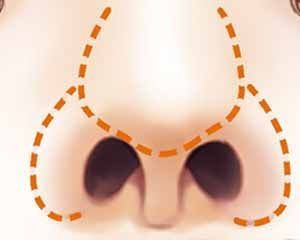 鼻子不好看能改善吗,大鼻子不好看怎么办