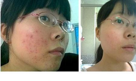 挤痘有刺痛感,挤痘为什么会留痘坑