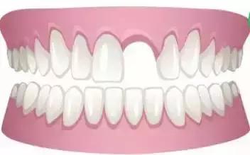 前牙有缝有什么说法吗,前牙有洞怎么补救