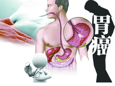 胃癌中医诊断病名,初步诊断恶性胃癌