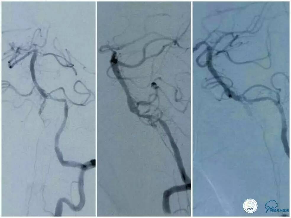 天坛周记|左椎V4段-基底动脉交界区狭窄的支架治疗