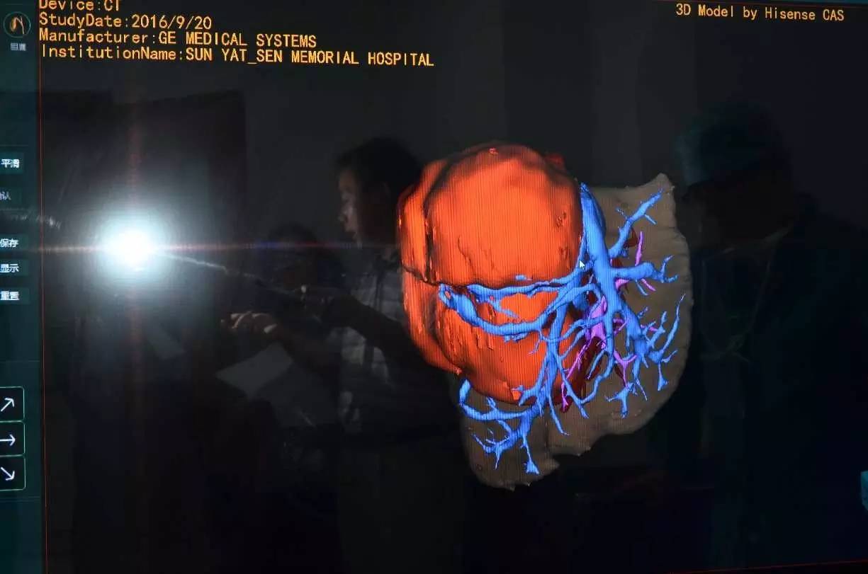 肝母细胞瘤手术在哪个位置开刀,医生微创取脑瘤