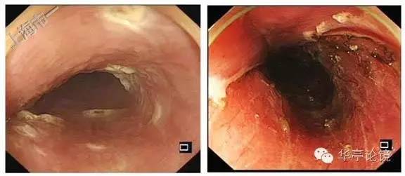 6个精彩病例带你领略早期食管癌的内镜下诊治