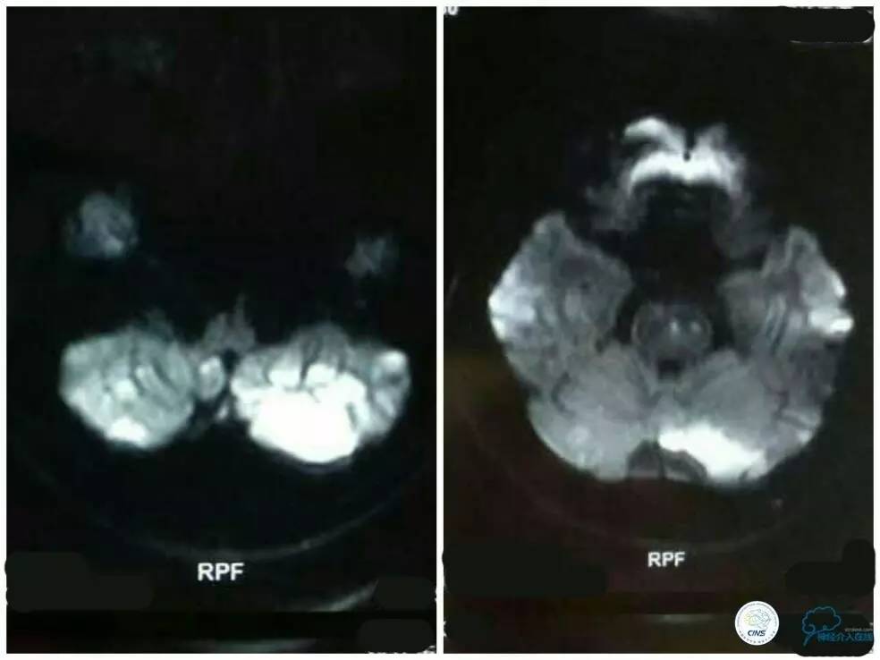天坛周记|左椎V4段-基底动脉交界区狭窄的支架治疗