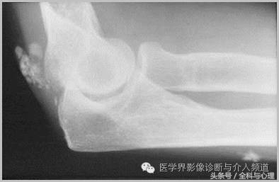 软组织钙化与骨化,软组织钙化和骨质增生