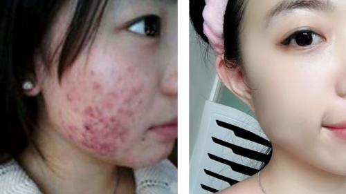 脸上长痘痘可以用什么祛痘产品,下巴长痘痘抹什么药膏最有效