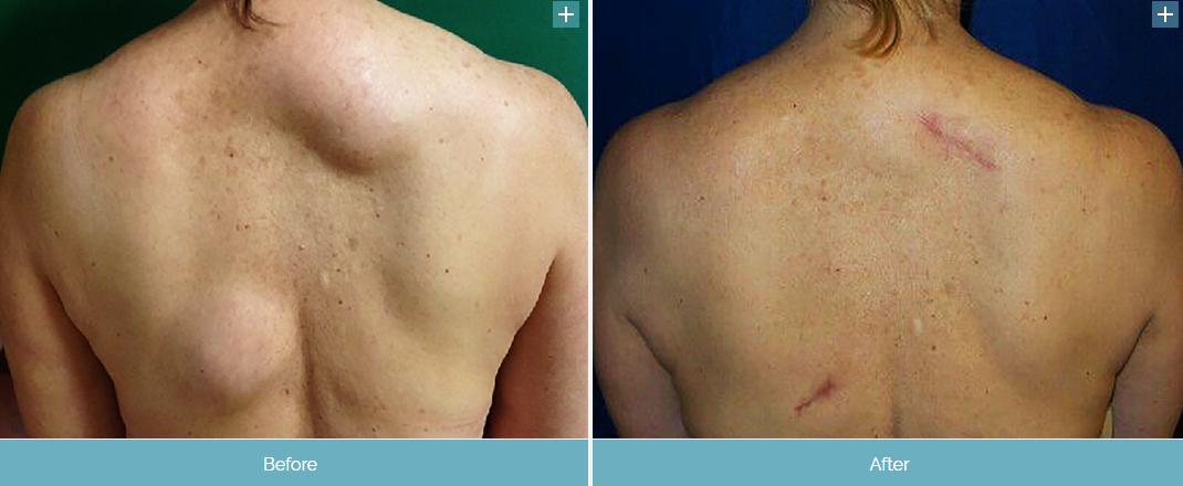 胃脂肪瘤有恶变吗,小肠脂肪瘤恶变吗