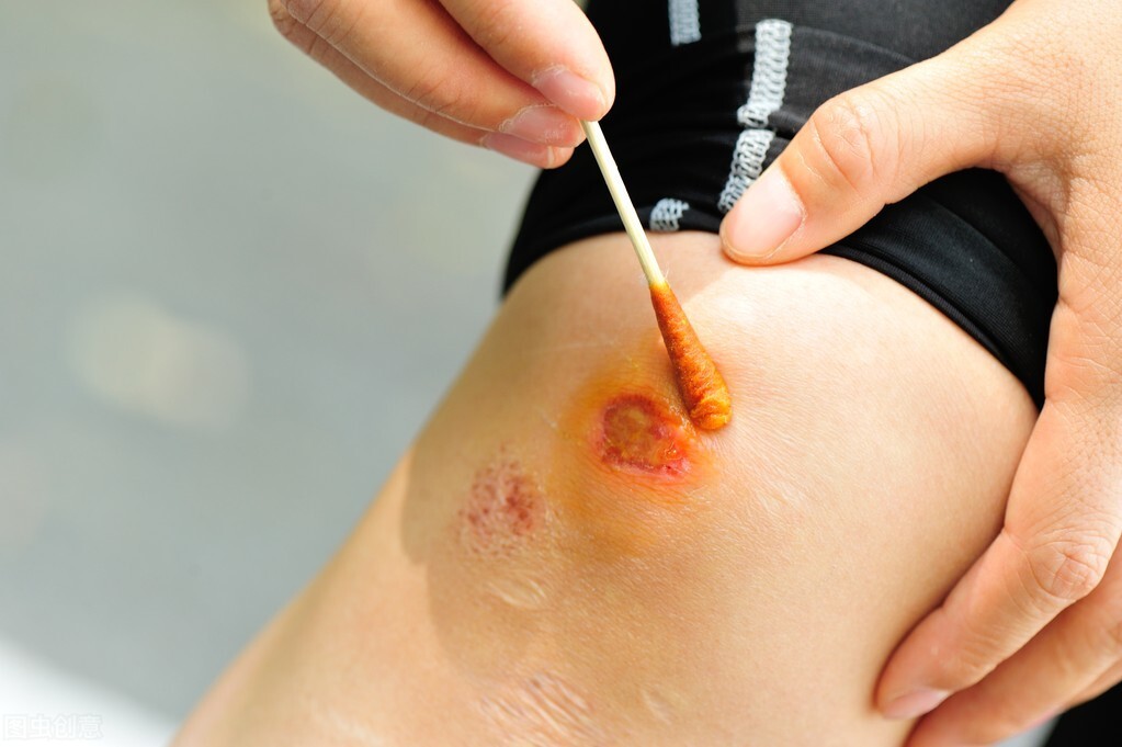 受伤的伤口发痒是什么原因,伤口愈合期发痒如何缓解