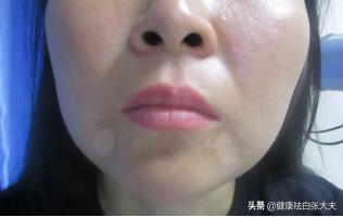 使用化妆品不当会引起白癜风吗,化妆品导致白癜风可能性大吗
