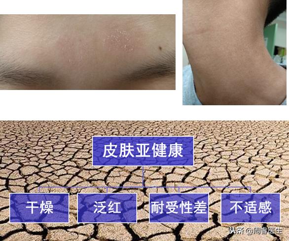 角化湿疹变硬的皮肤怎么恢复,擦湿疹药膏后皮肤变白会恢复吗